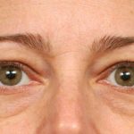 Eyelid Surgery Before & After Patient #1550