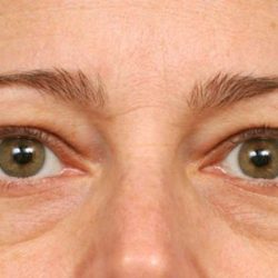 Eyelid Surgery Before & After Patient #1550