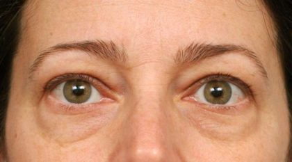 Eyelid Surgery Before & After Patient #1550