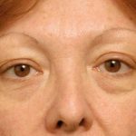 Eyelid Surgery Before & After Patient #1557