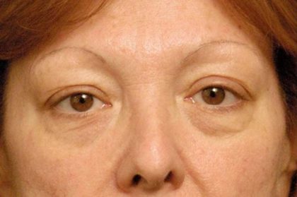 Eyelid Surgery Before & After Patient #1557