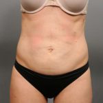 Tummy Tuck Before & After Patient #354