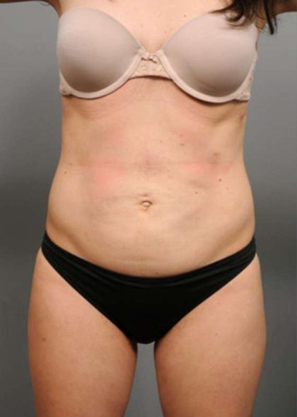 Tummy Tuck Before & After Patient #354