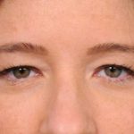 Eyelid Surgery Before & After Patient #1565