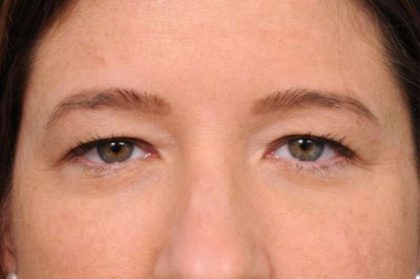 Eyelid Surgery Before & After Patient #1565