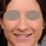 Rhinoplasty Before & After Patient #1572