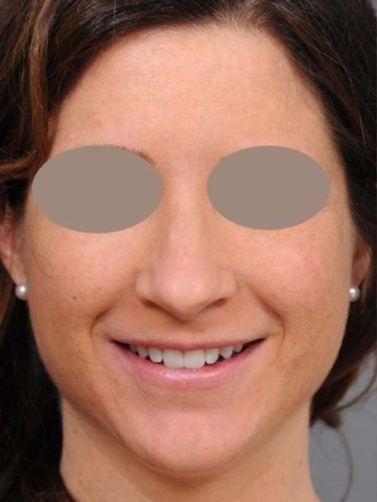 Rhinoplasty Before & After Patient #1572