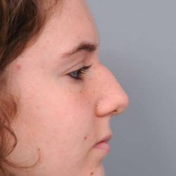 Rhinoplasty Before & After Patient #1591