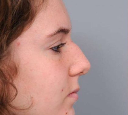 Rhinoplasty Before & After Patient #1591