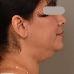 Neck Lift (Traditional) Before & After Patient #1596