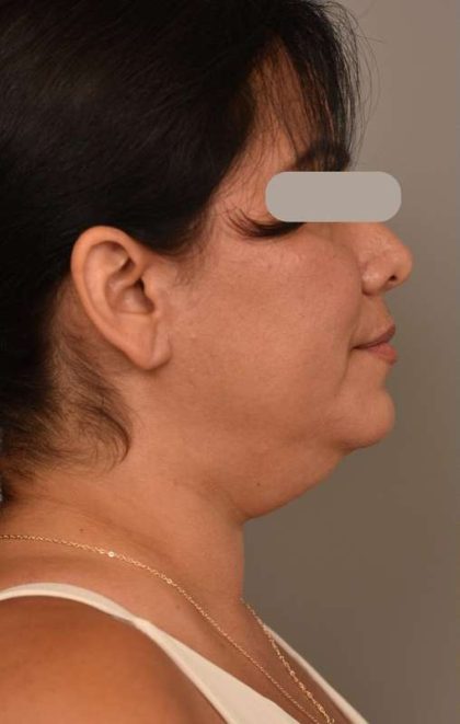 Neck Lift (Traditional) Before & After Patient #1596