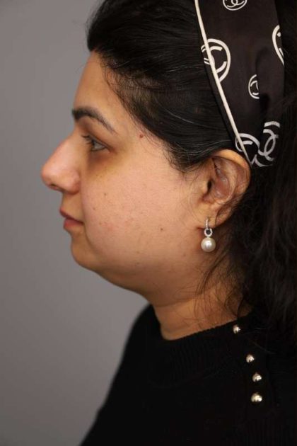 Neck Lift (Traditional) Before & After Patient #1605