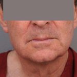 Neck Lift (Traditional) Before & After Patient #1612