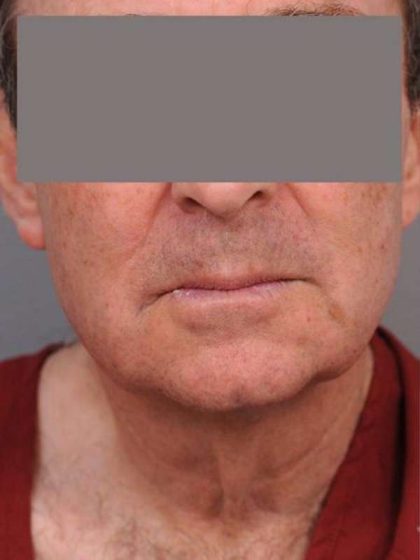 Neck Lift (Traditional) Before & After Patient #1612