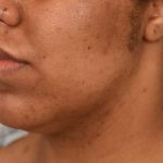 Neck Lift (Traditional) Before & After Patient #1621