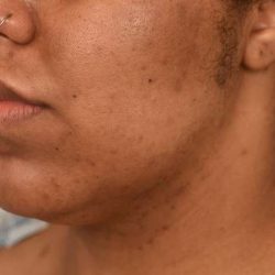 Neck Lift (Traditional) Before & After Patient #1621