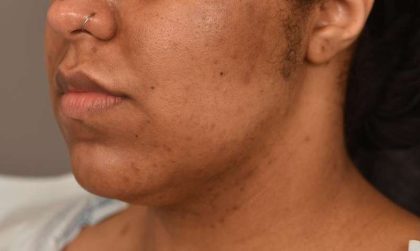 Neck Lift (Traditional) Before & After Patient #1621