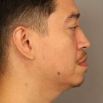 Mini Neck Lift (Single Incision) Before & After Patient #1630