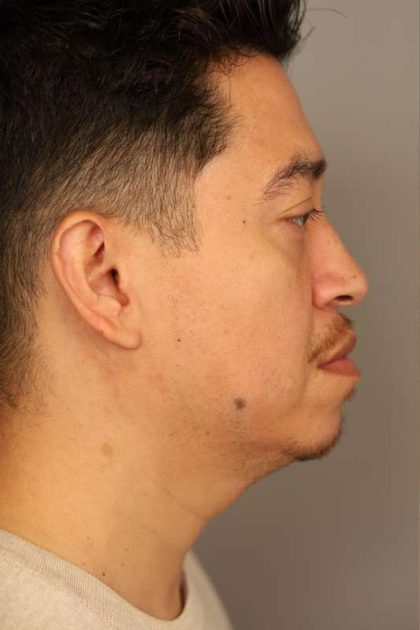 Mini Neck Lift (Single Incision) Before & After Patient #1630