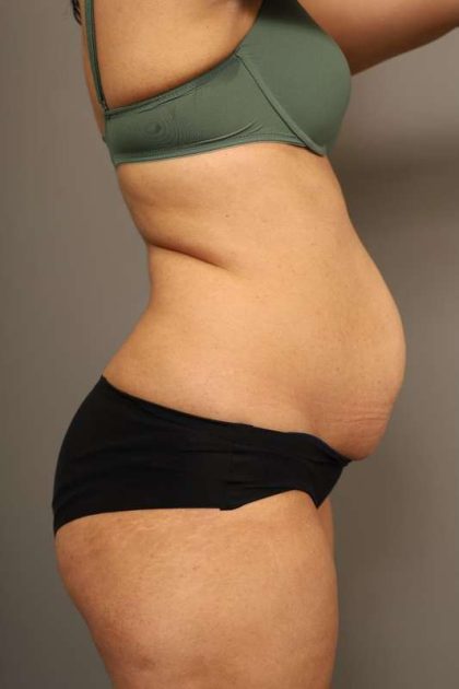 Tummy Tuck Before & After Patient #238