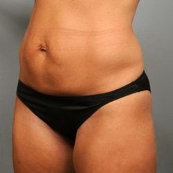 Tummy Tuck Before & After Patient #363