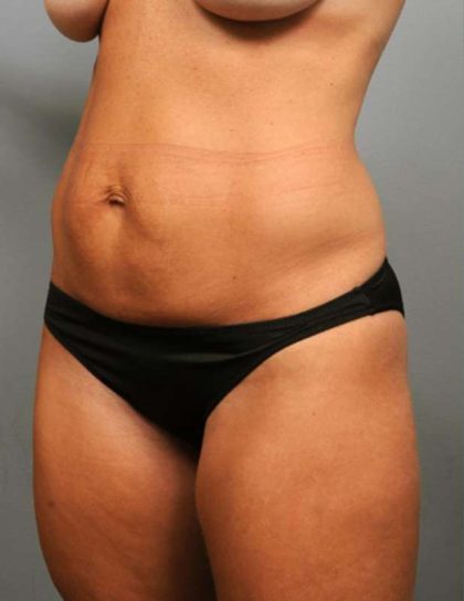 Tummy Tuck Before & After Patient #363
