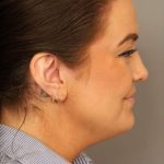 Mini Neck Lift (Single Incision) Before & After Patient #1637
