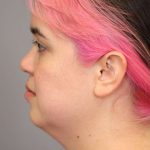 Mini Neck Lift (Single Incision) Before & After Patient #1646