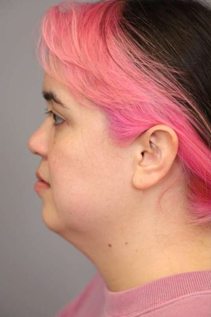 Mini Neck Lift (Single Incision) Before & After Patient #1646