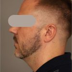 Mini Neck Lift (Single Incision) Before & After Patient #1653
