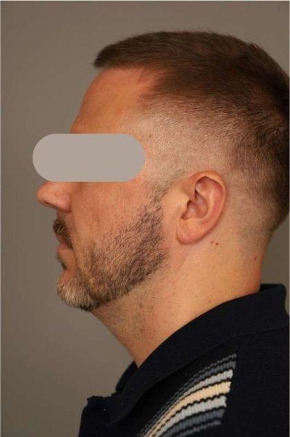 Mini Neck Lift (Single Incision) Before & After Patient #1653
