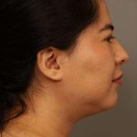 Mini Neck Lift (Single Incision) Before & After Patient #1662