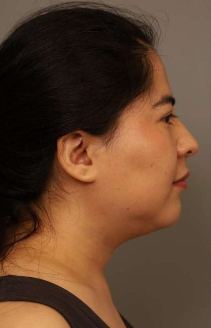 Mini Neck Lift (Single Incision) Before & After Patient #1662