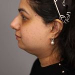 Mini Neck Lift (Single Incision) Before & After Patient #1671