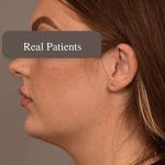 Mini Neck Lift (Single Incision) Before & After Patient #1674