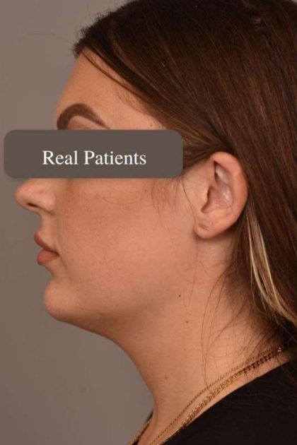 Mini Neck Lift (Single Incision) Before & After Patient #1674