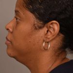 Mini Neck Lift (Single Incision) Before & After Patient #1679