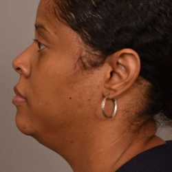 Mini Neck Lift (Single Incision) Before & After Patient #1679