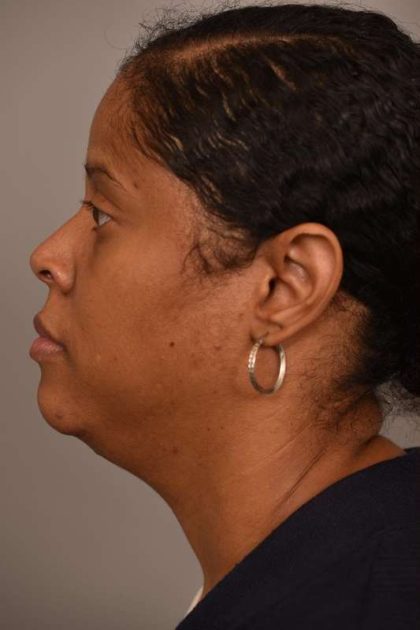 Mini Neck Lift (Single Incision) Before & After Patient #1679
