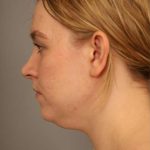 Mini Neck Lift (Single Incision) Before & After Patient #1690