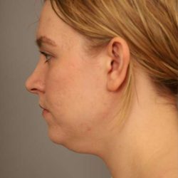 Mini Neck Lift (Single Incision) Before & After Patient #1690
