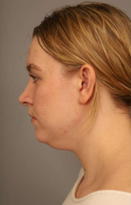Mini Neck Lift (Single Incision) Before & After Patient #1690