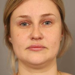 Neck Liposuction / Chin Liposuction Before & After Patient #1703