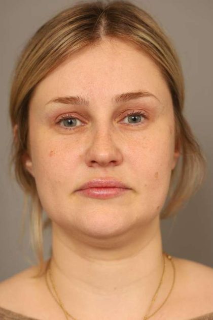Neck Liposuction / Chin Liposuction Before & After Patient #1703