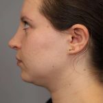 Neck Liposuction / Chin Liposuction Before & After Patient #1712