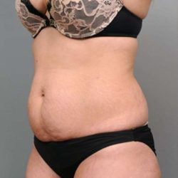 Tummy Tuck Before & After Patient #370
