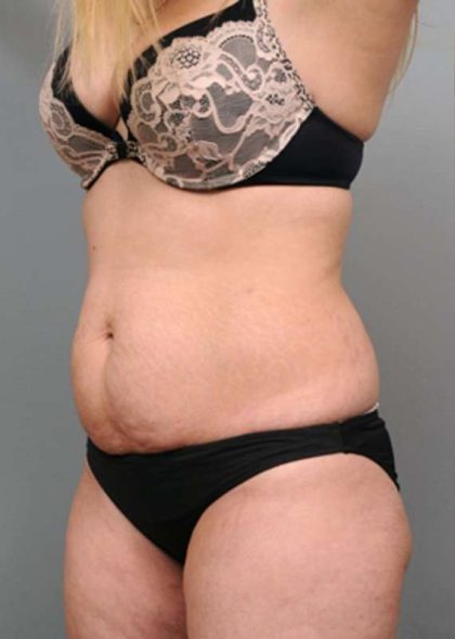 Tummy Tuck Before & After Patient #370