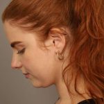 Neck Liposuction / Chin Liposuction Before & After Patient #1722
