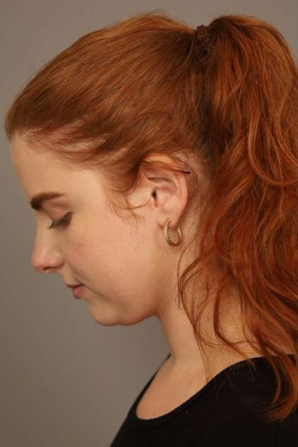 Neck Liposuction / Chin Liposuction Before & After Patient #1722