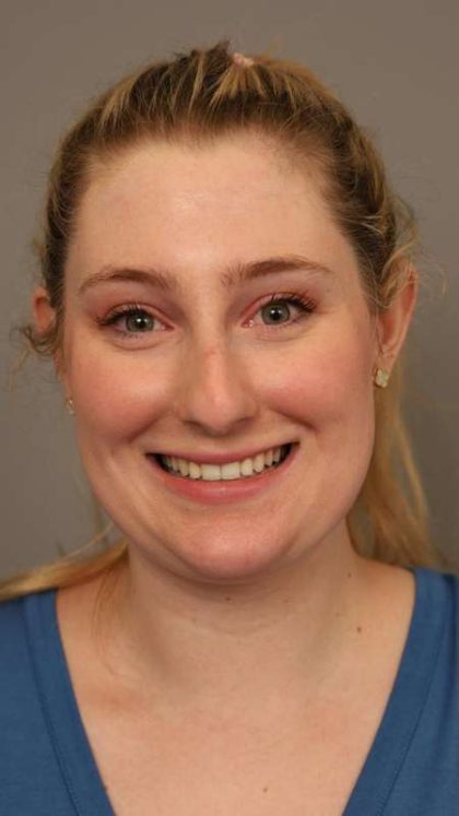 Neck Liposuction / Chin Liposuction Before & After Patient #1734